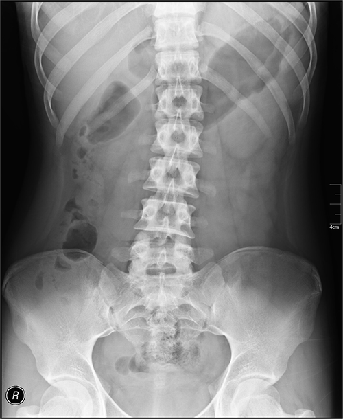 Abdominal X-ray interpretation example