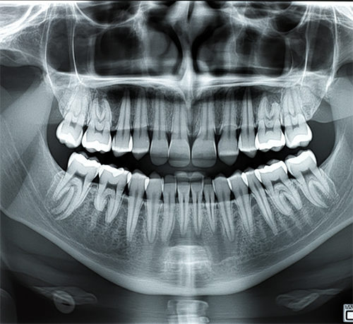 AI-powered dental X-ray interpretation example